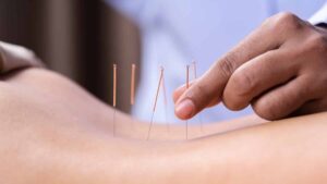 Woman Undergoing Acupuncture Treatment Back 1000x563 1